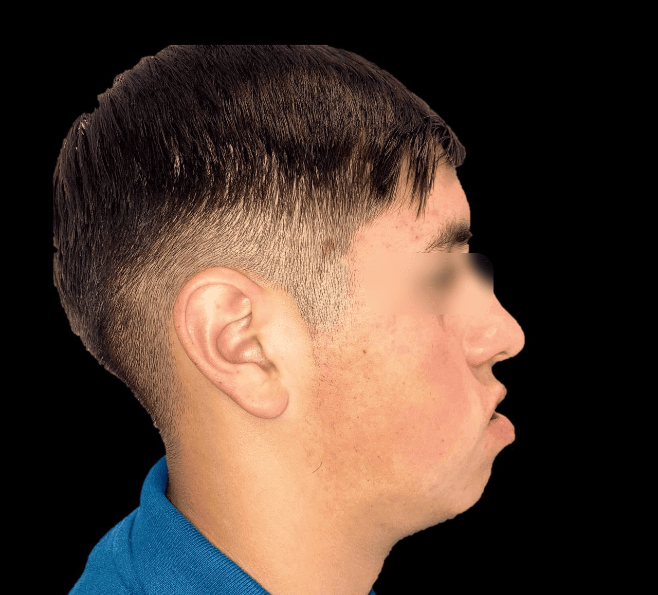 Paciente Anonimo – cirugía ortognática antes