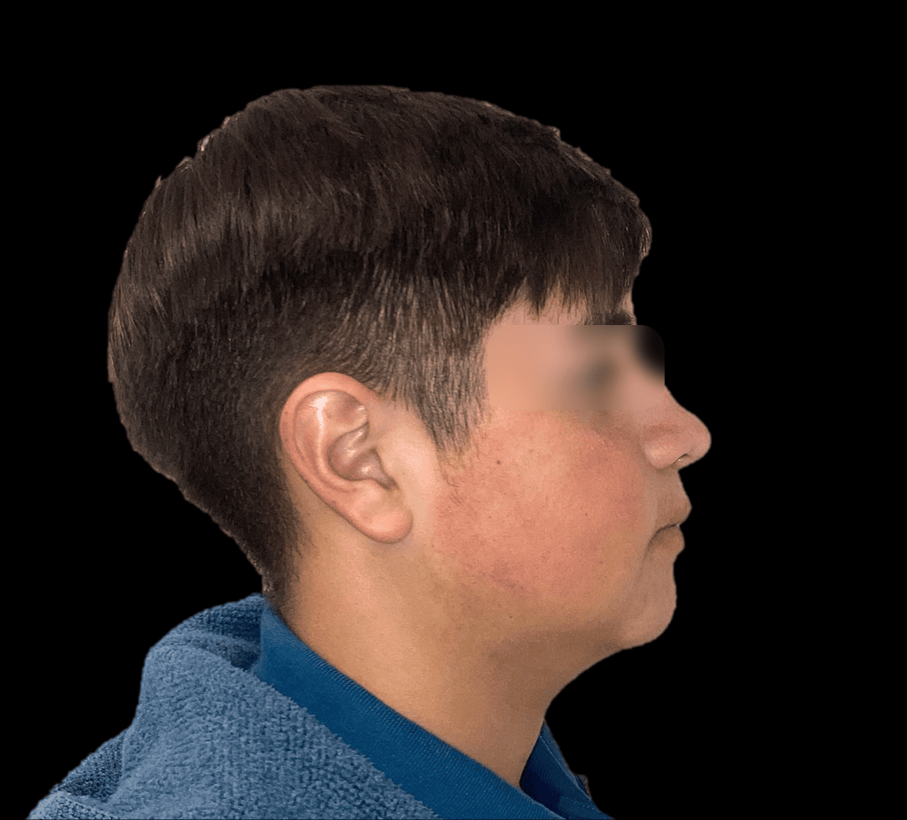 Paciente Anonimo – cirugía ortognática después